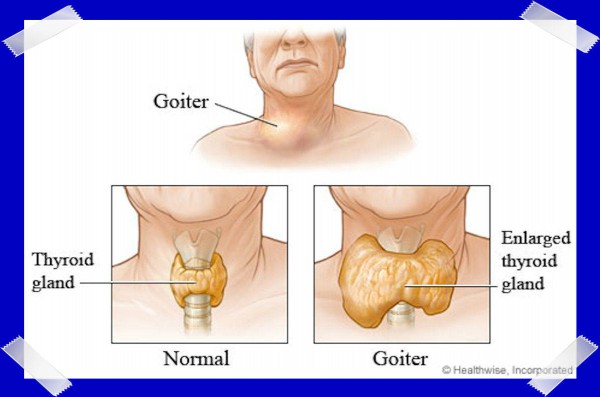 Thyroid Disease - Dysfunction