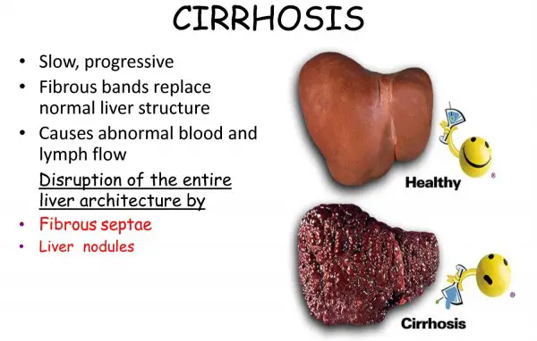All About Cirrhosis