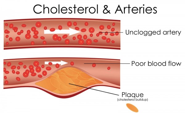 Cholesterol Levels & Arteries