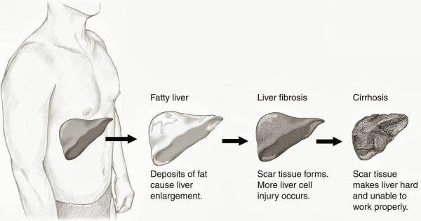 Cirrhosis Liver