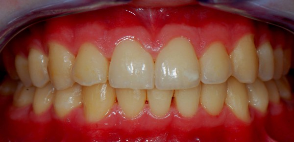 Gingivitis - After Treatment