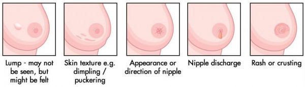 Breast Cancer - Signs To Look For