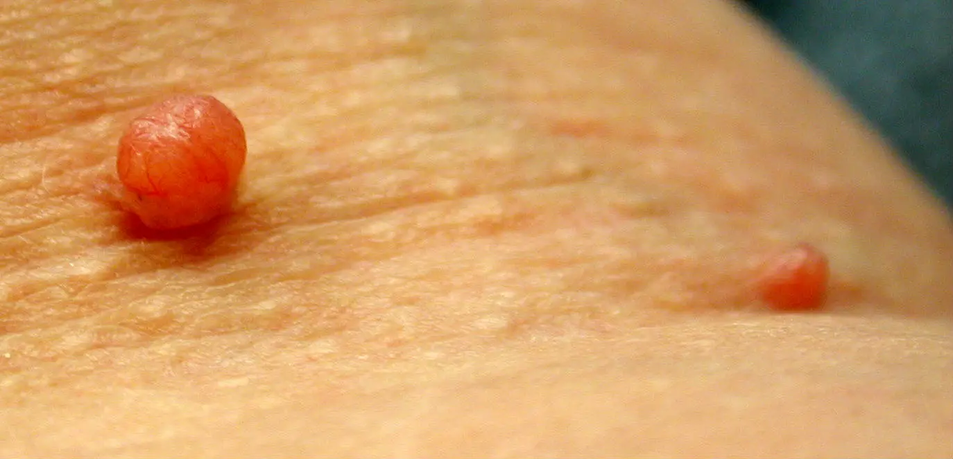 How To Remove Skin Tag Quickly With Apple Cider Vinegar?