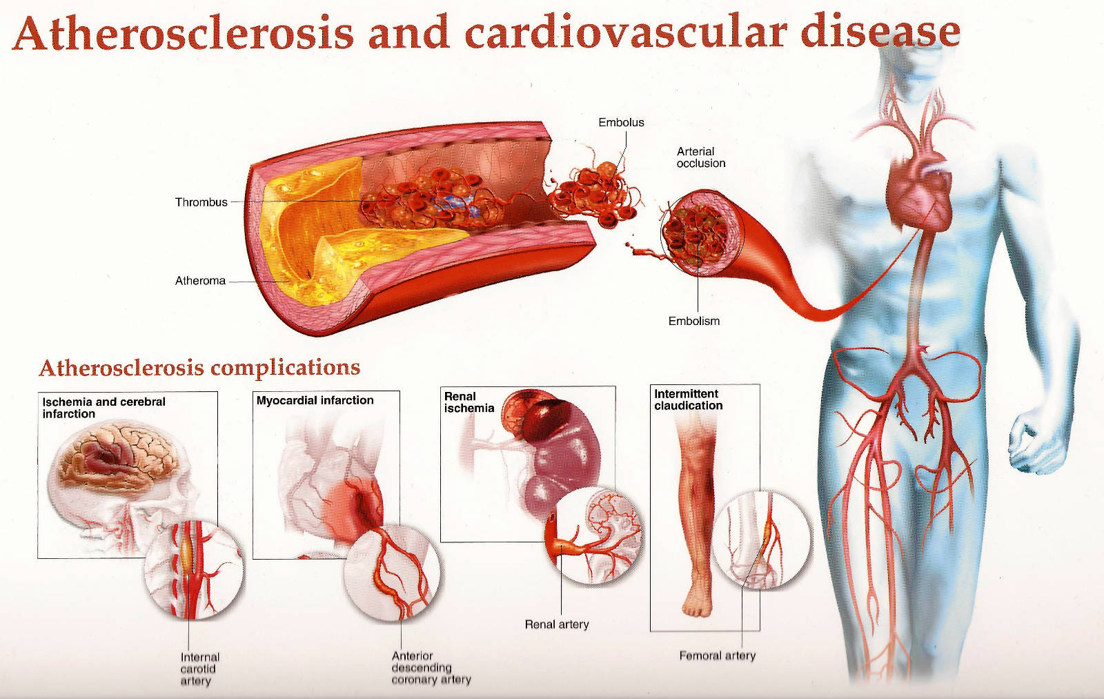 Atherosclerosis - Purify Your Clogged Arteries 2