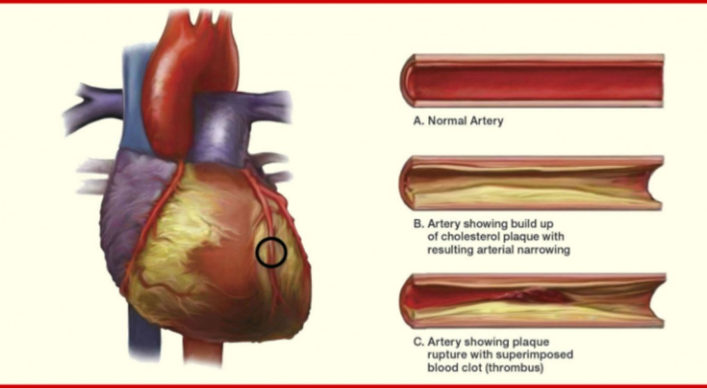 Atherosclerosis - Purify Your Clogged Arteries with This Old German ...