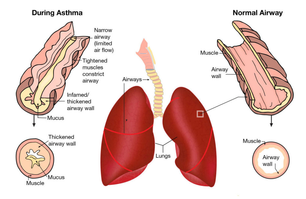 Remedy for Asthma