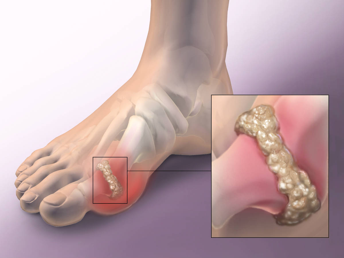 Uric Acid Crystals in Joints