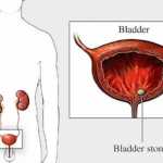 Strongest Natural Antibiotic for Every Bladder Infection