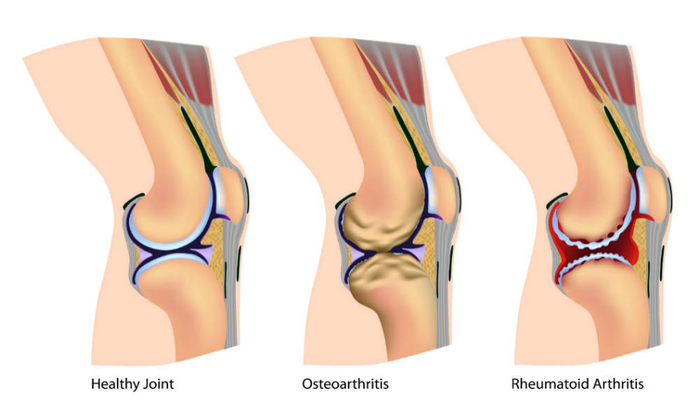 How To Use Sesame Seeds and Turmeric For Knee Osteoarthritis Featured