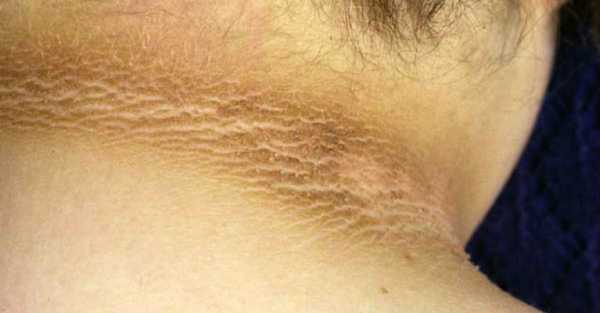 comprehensive-guide-for-removing-dry-dark-skin-on-your-neck-elbows