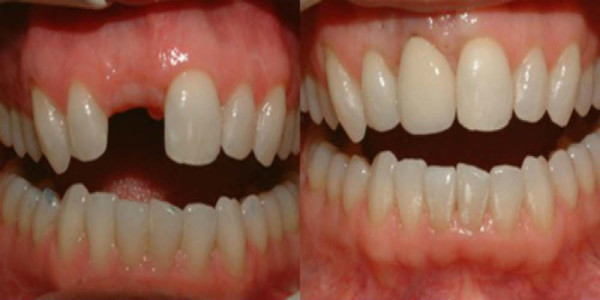 Stem-Cell Dental Implants Grow New Teeth in Your Mouth