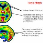 Panic Attacks and Anxiety Linked to Low Vitamin B and Levels: Study