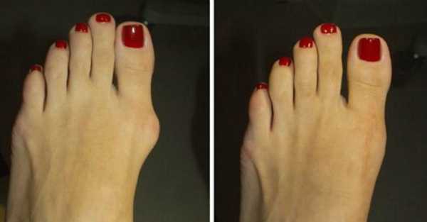 5 Ways To Ease Your Bunions Without Surgery – Health And Love Page