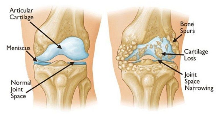 Get Rid of Joint, Back And Knee Pain With This Superfood in Less Than a Week