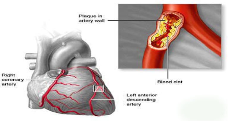 Save Your Heart, Kidneys, and Brain Clean Your Arteries