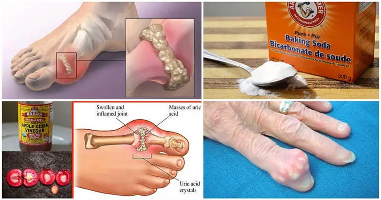 How To Quickly Remove Uric Acid Crystallization From Your Body To