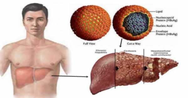 Hepatitis B Home Treatment Tips to Help You Feel Better