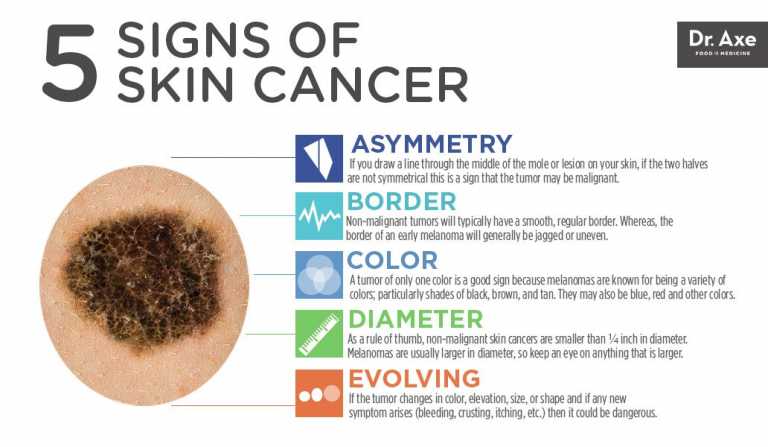 Top 5 Skin Cancer Symptoms And 4 Natural Treatments Health And Love Page