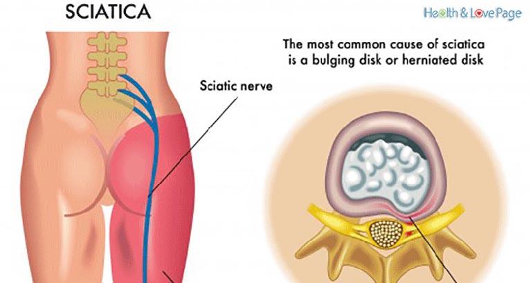  the inflammation of the sciatica and relieving the painful sensation