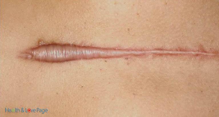 keloids-and-scars-away-natural-cures