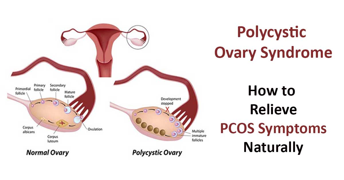5 Home Remedies for Polycystic Ovary Syndrome (PCOS)