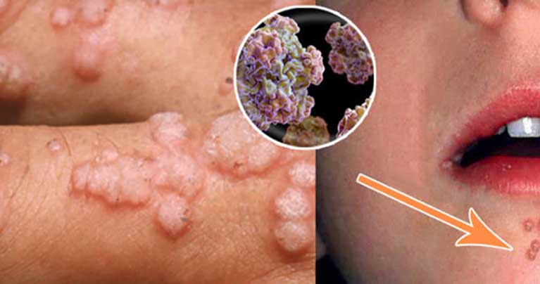 can male genital warts cause cervical cancer