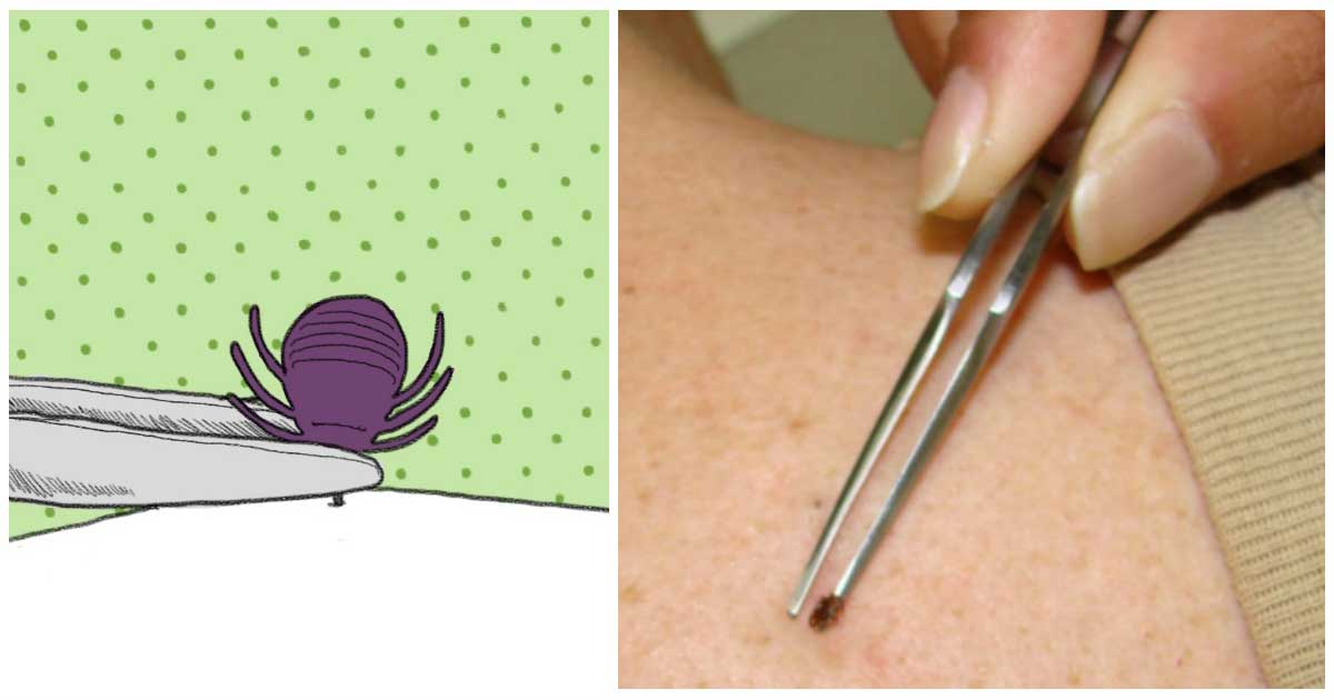 things-you-should-or-shouldn-t-do-when-you-find-a-tick-stuck-on-your-skin